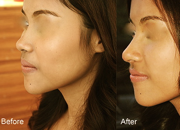 รีวิวลูกค้าฉีดFiller