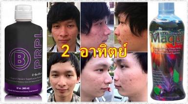 ลดสิว ทำให้หน้าใส โดยไม่ต้องพึ่งคลินิกต่างๆ แค่ทานB-PRPL ค่ะ สุดยอดดดด