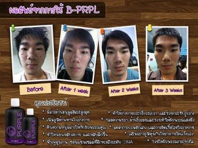 ลดสิว ทำให้หน้าใส โดยไม่ต้องพึ่งคลินิกต่างๆ แค่ทานB-PRPL ค่ะ สุดยอดดดด