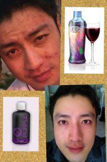 ลดสิว ทำให้หน้าใส โดยไม่ต้องพึ่งคลินิกต่างๆ แค่ทานB-PRPL ค่ะ สุดยอดดดด