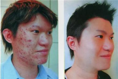 ลดสิว ทำให้หน้าใส โดยไม่ต้องพึ่งคลินิกต่างๆ แค่ทานB-PRPL ค่ะ สุดยอดดดด