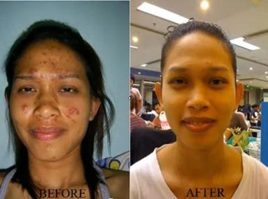 หน้าใส มั่นใจขึ้นเยอะค่ะ ^^