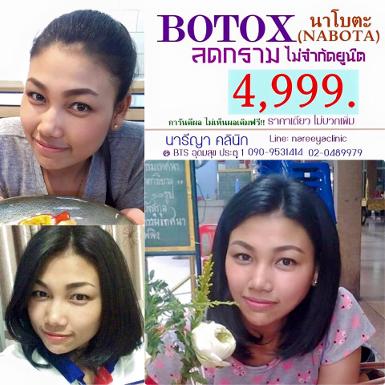 โบท้อกลดกรามนาโบตะ 4999ไม่จำกัดยูนิต ฟรีวิตามินผิว