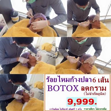 ร้อยไหมก้างปลา6เส้น+โบท้อกลดกราม9900บาทท